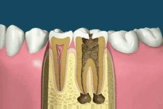 ENDODONCIJA - lečenje zuba
